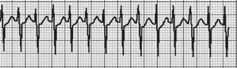 Typical AVNRT Note Narrow QRS Complex Tachycardia With No P Waves Seen Download Scientific
