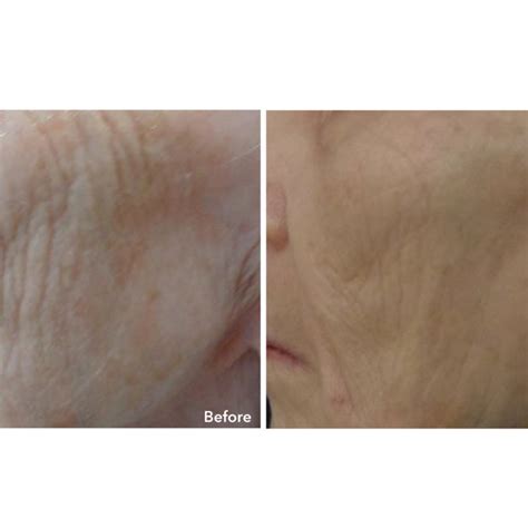Anteage Md Microneedling 67 Degrees Cosmetic Clinic