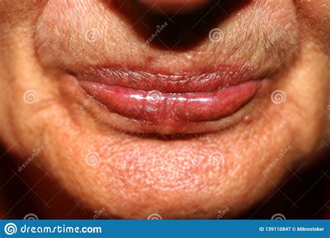 Lips With Lowered Corners Wrinkles On The Lips Nasolabial Folds