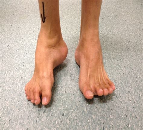 Foot Deformity Singapore Surgery Reconstruction Treatment