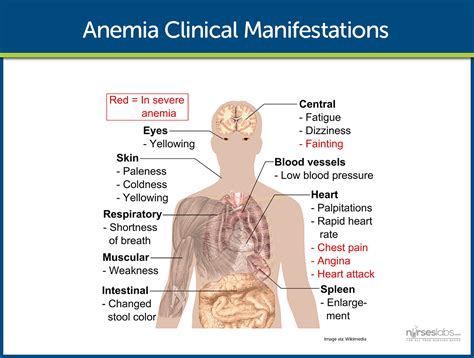 Anemia Nursing Care Management A Study Guide