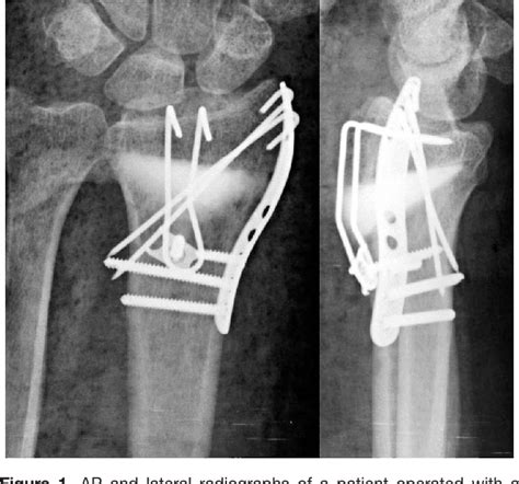 Figure 1 From Osteotomy Of Distal Radius Fracture Malunion Using A Fast