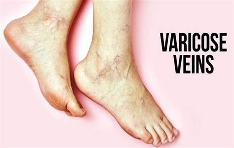 Varicose Veins Symptoms Causes And Treatment