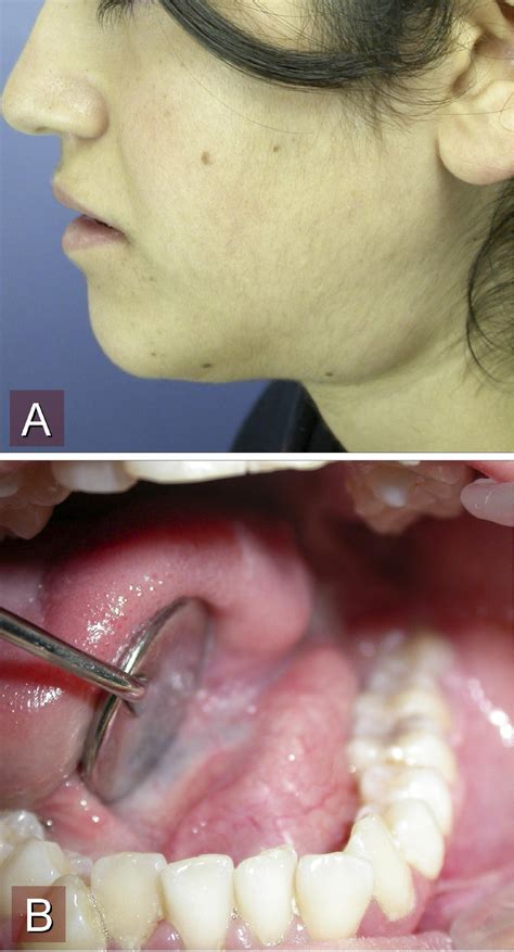 Dermoid Cysts Of The Lateral Floor Of The Mouth A Comprehensive