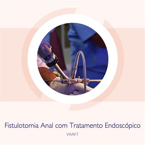 Vaaft Fistulotomia Anal Com Tratamento Endoscópico Proctoclin