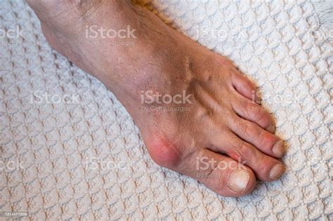 Inflamed And Deformed Joints On The Leg Gouty Toes Toes Affected By