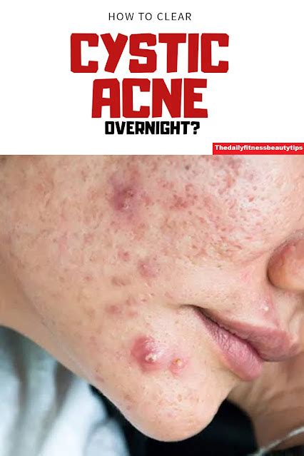 How To Get Rid Of Cystic Acne