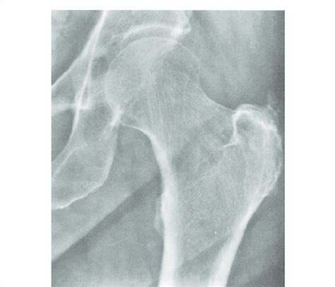 X Rays Of The Hip Of Patient With Great Trochanteric Pain Syndrome