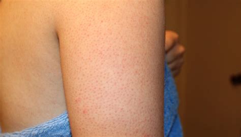 This Is The Reason Youre Getting Red Bumps On Your Arms Smooth