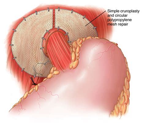 Types Of Hiatal Hernia Surgery
