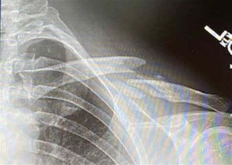 Clavicle Fractures Broken Collarbone Orthopedic Shoulder Specialist