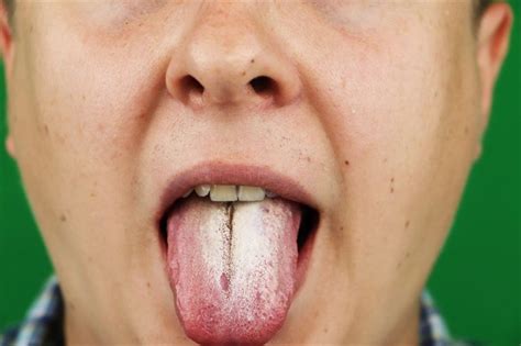 Normal Tongue Vs Thrush