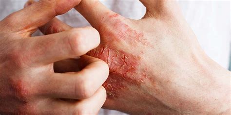 krokodil drug effects drug addiction florida addiction