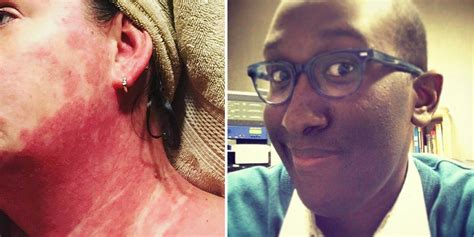 26 Photos That Show How Autoimmune Disease Affects The Skin The Mighty