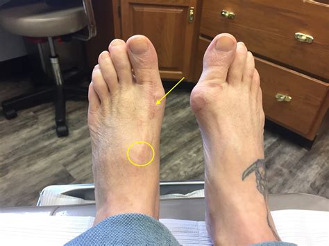Before During And After Bunion Surgery Preparing For Bunion Surgery