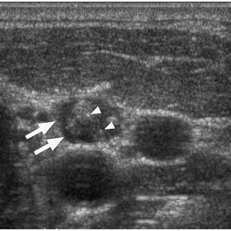Transverse Grey Scale Sonogram Of A Metastatic Lymph Node From