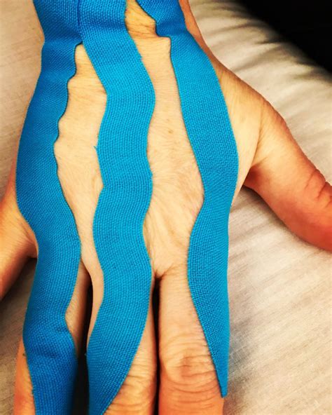 Lymphoedema And Neuropathy Of The Hand Taping Redirecting Swelling