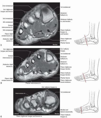 Neurovascular abnormalities and skin abnormalities in the affected limb were identified on mri in 1 and 2 patients, respectively. Foot, Ankle, and Calf | Musculoskeletal Key
