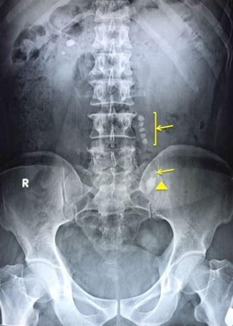 Chain Of Migrating Ureteral Calculi A Cat And Mouse Game Bmj Case