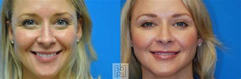 Dermal Fillers Before And After Pictures Case 140 Torrance Ca