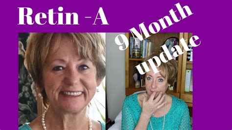 Retin A Tretinoin 9 Month Update Before And After Pics Monikas
