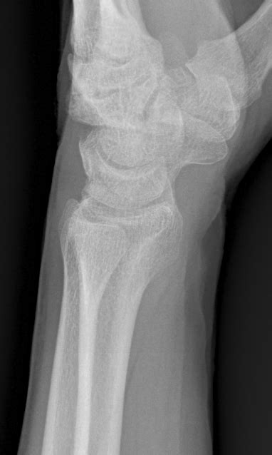 A Review On Reading Wrist X Rays Sports Medicine Review