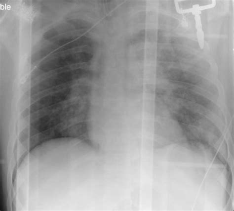 Maybe you would like to learn more about one of these? The Emergency Medicine Resident Blog • Hemothorax and the ...