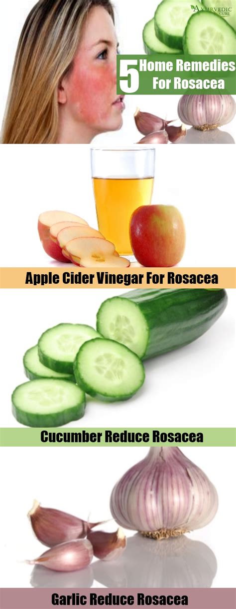 Top 5 Home Remedies For Rosacea Natural Treatments And Cures