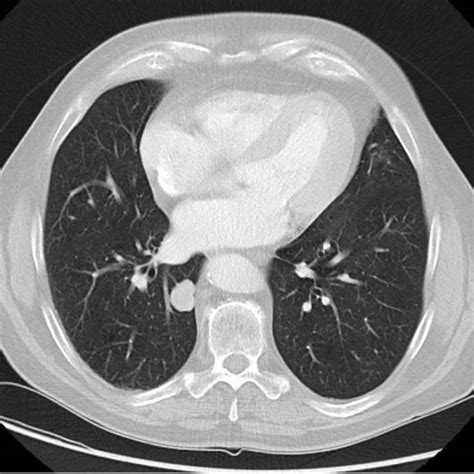 Nodular Lesion In The Right Lower Lobe On Ct Scan Fig 2