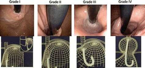 Hill Hiatal Hernia