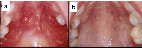 Ab Diffuse Infiltration Of The Palatal Mucosa With Strawberry
