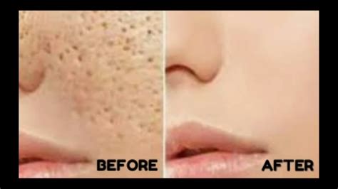 How To Shrink Reducelarge Open Pores And Tighten Skin Permanently Youtube