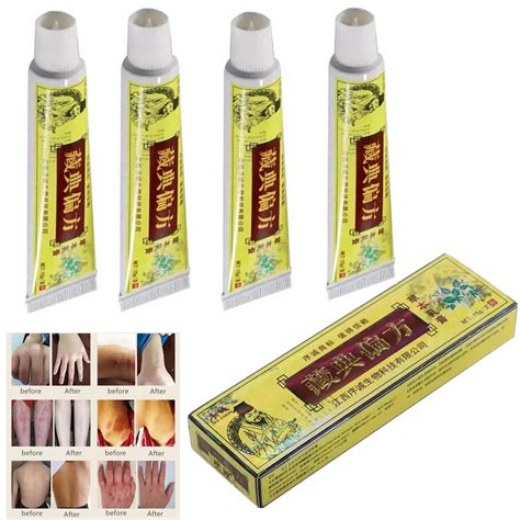 Buy 4pcs Natural Chinese Al Eczema Psoriasis Cream Dermatitis Pruritus