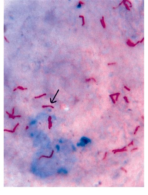 Microphotograph Of Tb Bacillus Mycobacterium Tuberculosis On An