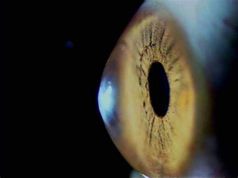 Keratoconus Bulging Cornea Causes And Treatment Milan Eye Center