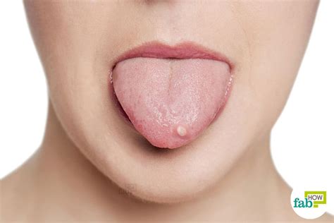 How To Get Rid Of Tongue Blisters Disinfect And Heal The