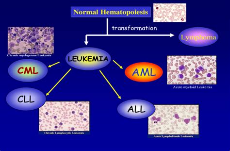 Types Of Leukemia Resulting From Abnormal Hematopoiesis Download