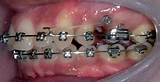 Miniscrew Orthodontic Pictures