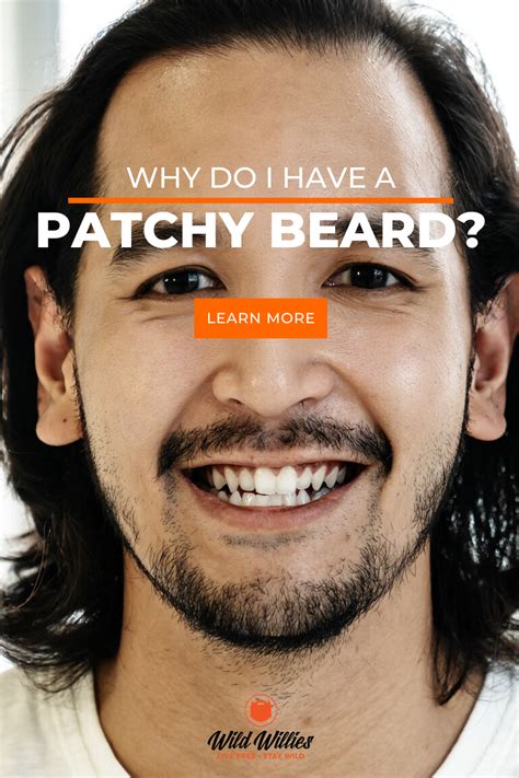 Ultimate Guide To Fixing Your Beard Bald Spot Patchy Beard Beard