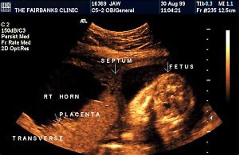 Recognizing Intra Amniotic Band Like Structures On Obstetric Ultrasound