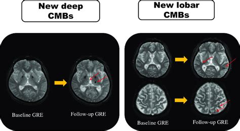 An Illustration Of Mri In The Two Patients Who Showed Different Types