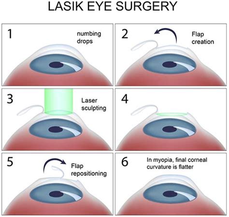 Lasik Surgery Laser Eye Surgery Refractive Surgery Nepal