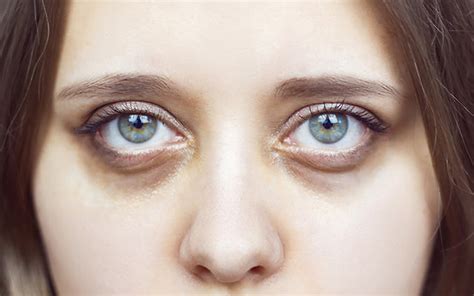 Dark Circles Under Eyes Causes Treatments And Preventive Tips Vedix