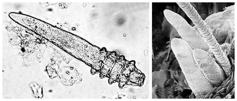 Demodex Mijt Uitleg Van De Dermatoloog