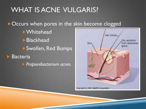 Ppt The Pharmaceutical Treatment Of Acne Vulgaris Powerpoint