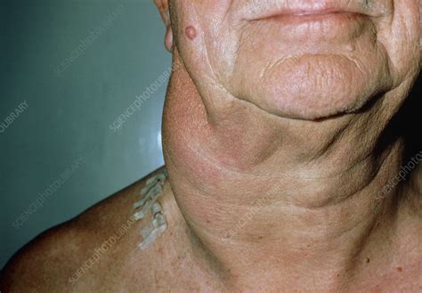 Non Hodgkins Lymphoma Neck Lymphadenopathy Stock Image M1310141