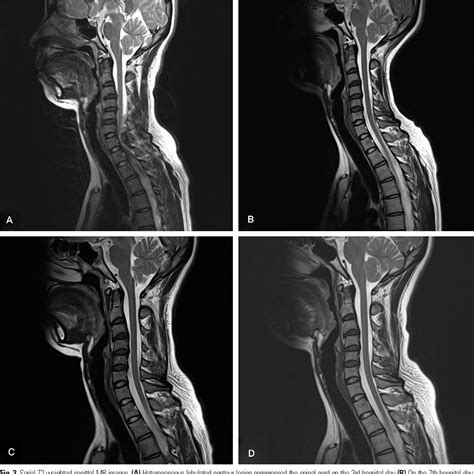 Figure 3 From Acute Spontaneous Cervical Spinal Epidural Hematoma With