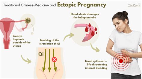 Ectopic Pregnancy Treatment And Prevention With Tcm Ginsen