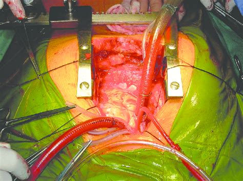 Cardiac Surgerymedian Sternotomy Incision A Perioperative Image