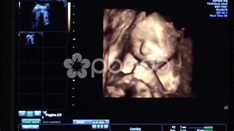 25 Weeks Pregnant Ultrasound Boy